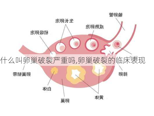 什么叫卵巢破裂严重吗,卵巢破裂的临床表现