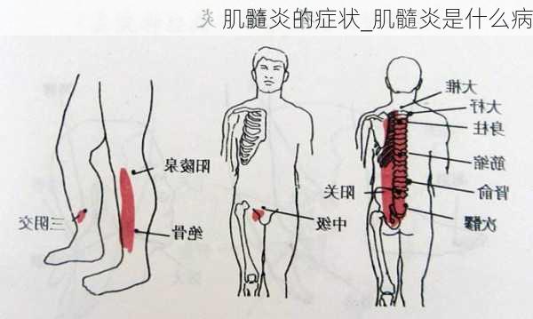 肌髓炎的症状_肌髓炎是什么病